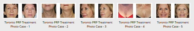 PRP Before and After Photos