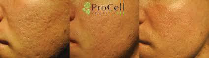 Procell Significant